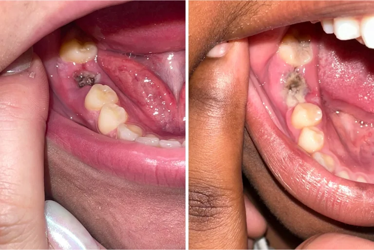 Dry Socket vs Normal Healing